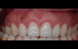 Smile Gallery - Before and After 4