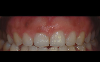 Smile Gallery - Before and After 1