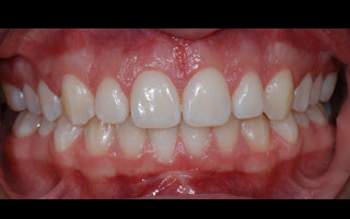 Smile Gallery - Before and After 5