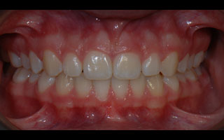 Smile Gallery - Before and After 2