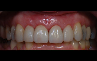 Smile Gallery - Before and After 6