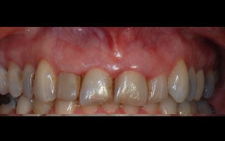 Smile Gallery - Before and After 3