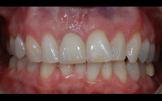 Smile Gallery - Before and After 10