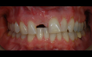 Smile Gallery - Before and After 7