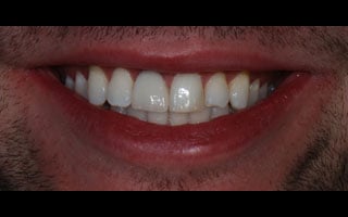 Smile Gallery - Before and After 11