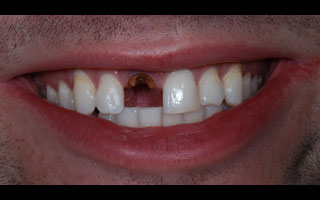 Smile Gallery - Before and After 8