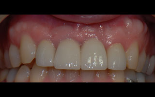 Smile Gallery - Before and After 12