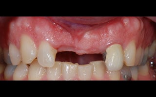 Smile Gallery - Before and After 9
