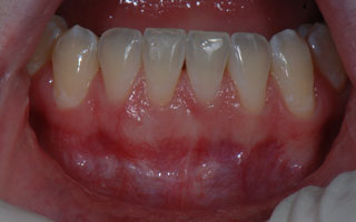 Smile Gallery - Before and After 18