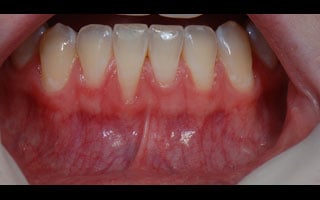 Smile Gallery - Before and After 13