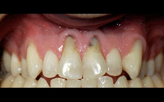 Smile Gallery - Before and After 14