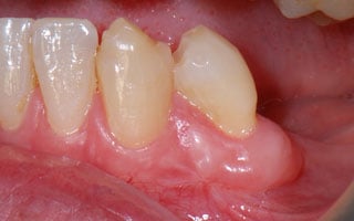 Smile Gallery - Before and After 20
