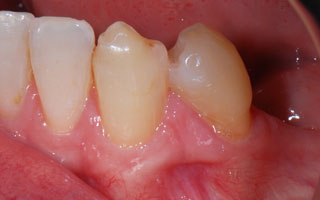 Smile Gallery - Before and After 15