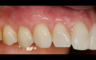 Smile Gallery - Before and After 21