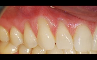 Smile Gallery - Before and After 16