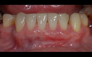 Gum Grafting - After