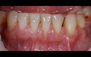 Gum Grafting - Before